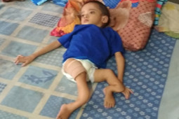 Osteogenesis Imperfecta Penyakit Tulang Rapuh, Bisakah Disembuhkan?