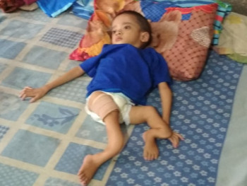 Osteogenesis Imperfecta Penyakit Tulang Rapuh, Bisakah Disembuhkan?