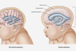 Bukan Cuma Bayi, Lansia Juga Bisa Idap Hidrosefalus