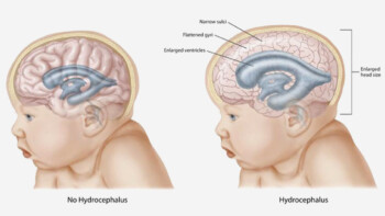 Bukan Cuma Bayi, Lansia Juga Bisa Idap Hidrosefalus