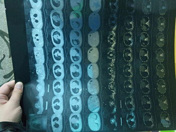 Wabah Virus Mutan dari Wuhan