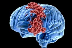 Mengenal Kanker Paling Agresif, Giloblastoma