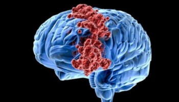 Mengenal Kanker Paling Agresif, Giloblastoma