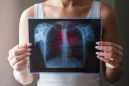 Indonesia Jadi Nomor 3 di Dunia Kasus Terbanyak, Ini Fakta-Fakta Tuberkulosis