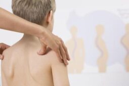Deretan Artis Ini Mengidap Skoliosis, Siapa Saja?