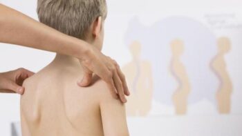 Deretan Artis Ini Mengidap Skoliosis, Siapa Saja?