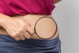 Menghilangkan Strech Mark di Tubuh dengan Cara Alami