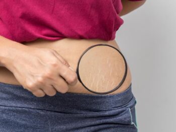 Menghilangkan Strech Mark di Tubuh dengan Cara Alami