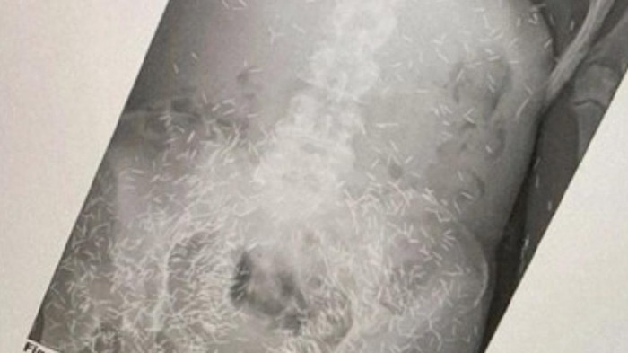 Fenomena Corpus Alienum yang Pernah Terjadi, Mulai Ratusan Susuk Hingga Kawat di Dalam Tubuh