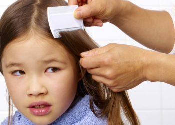 Ini Lho Tips Mengatasi Kutu Rambut