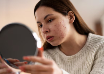 Kenali Cara Memilih Serum Tepat untuk Hilangkan Noda Jerawat   