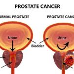 Penyebab dan Gejala Kanker Prostat