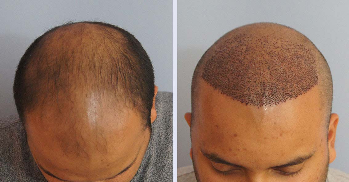 Hair Transplant ranchi10