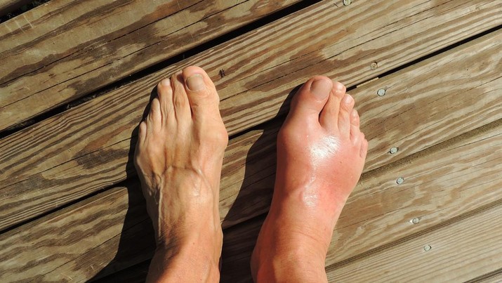 asam-urat-dan-nyeri-kaki_169